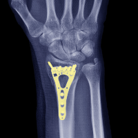 Imagem do produto MÉTODO YOUFISIO - FRATURA DO RÁDIO E/OU ULNA DISTAL - PLACA