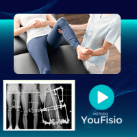 Imagem do curso MÉTODO YOUFISIO - FRATURA DIAFISÁRIA DO FÊMUR - FIXADOR EXTERNO