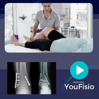 Imagem do produto MÉTODO YOUFISIO - FRATURA DO TORNOZELO BIMALEOLAR - PLACA E PARAFUSOS