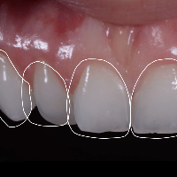 TEMPLATE FAST SMILE DESIGN
