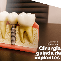 Imagem do produto e-book sobre cirurgia guiada de implantes para dentistas