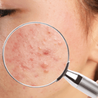 Imagem do produto Acabe Com Cravos E Espinhas Em 3  Dias!