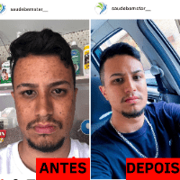 Imagem do produto FORMULA NATURAL PARA ACABAR COM MANCHAS DE PELE