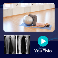 Imagem do curso MÉTODO YOUFISIO - FRATURA DIAFISÁRIA DE TÍBIA - FIXADOR EXTERNO